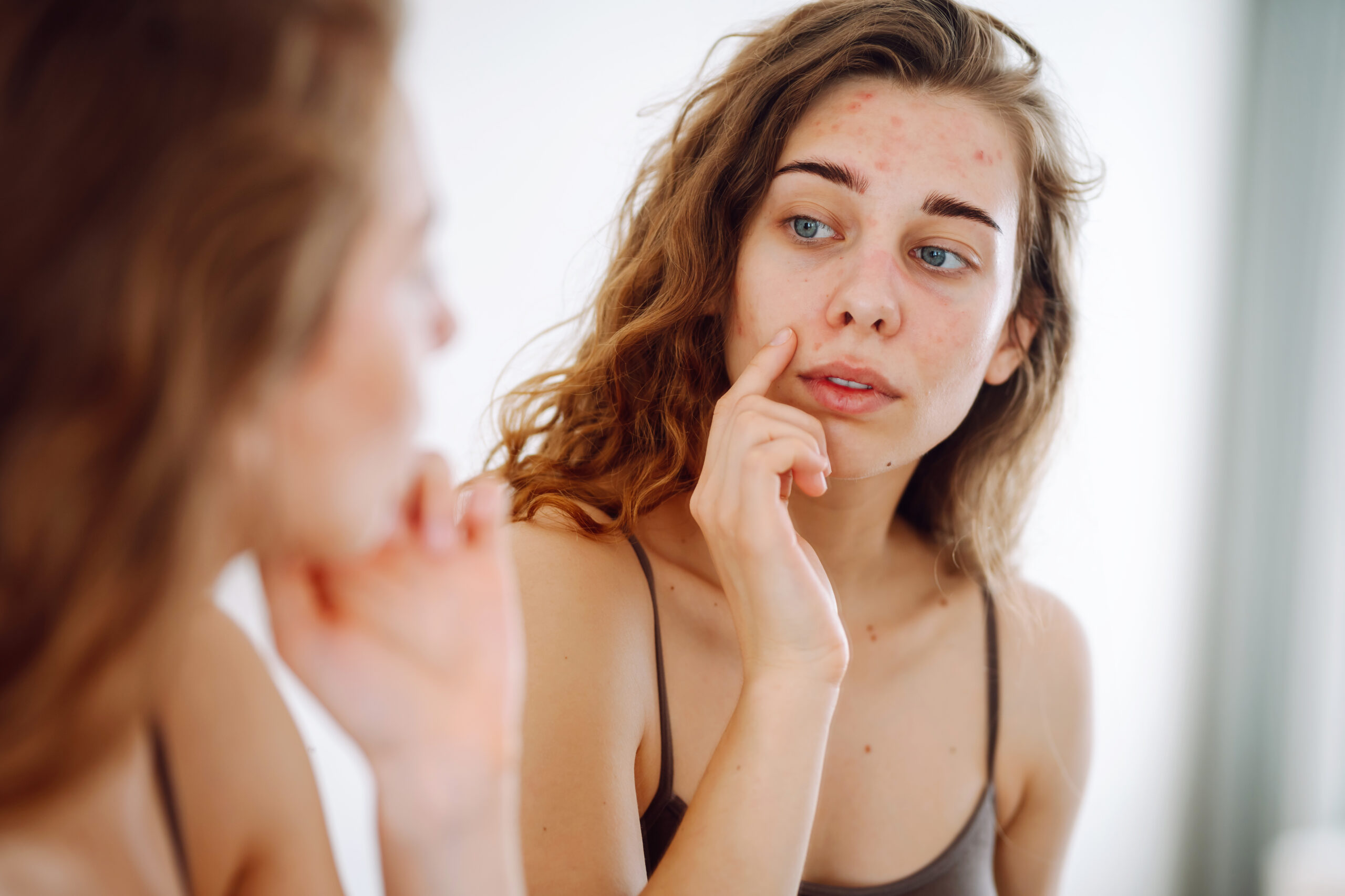 Espironolactona no tratamento da acne