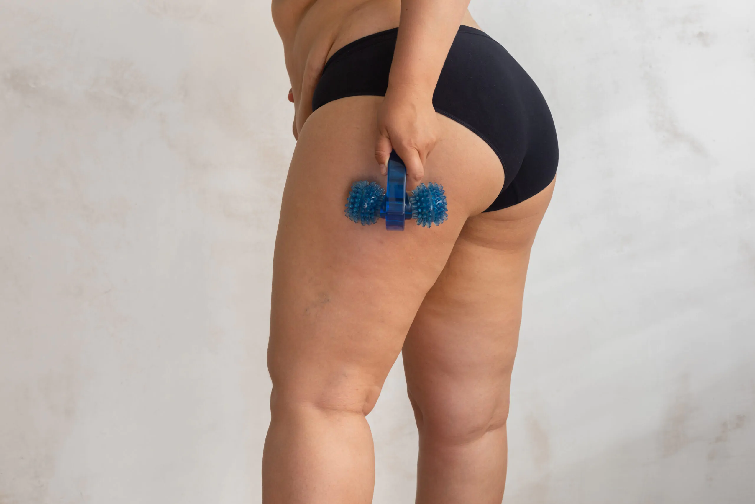 Lipedema